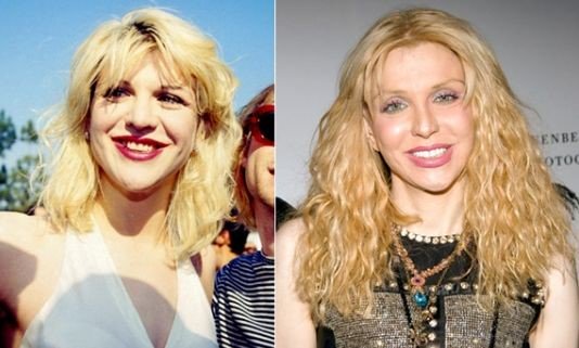 Courtney Love Plastic Surgery Gone Wrong