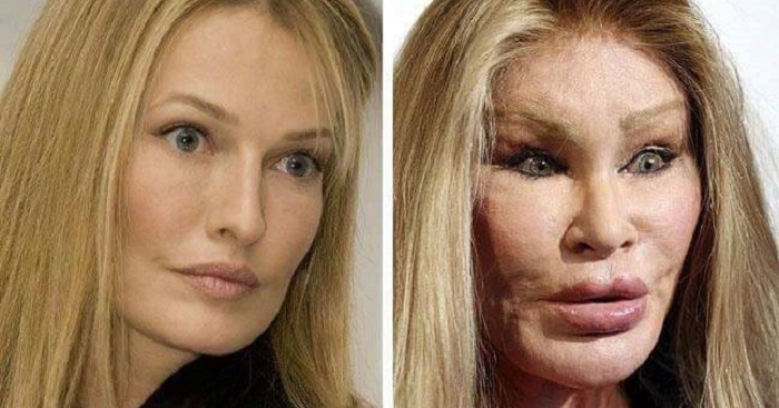 Jocelyn Wildenstein Plastic Surgery Gone Wrong