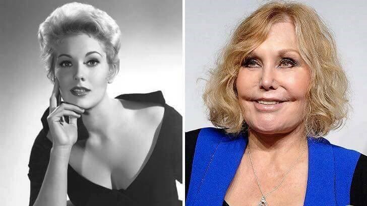 Kim Novak Plastic Surgery Gone Wrong