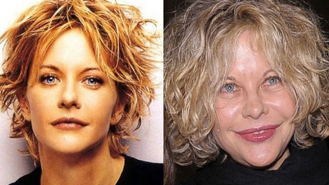 Meg Ryan Plastic Surgery Gone Wrong