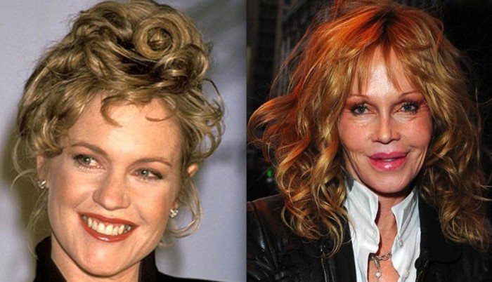 Melanie Griffith Plastic Surgery Gone Wrong