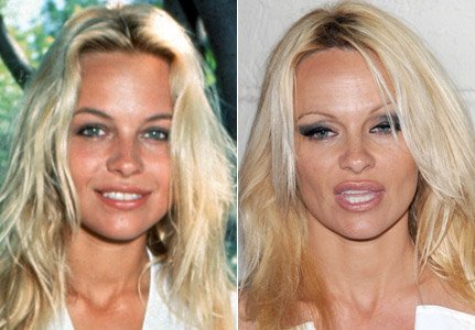 Pamela Anderson Plastic Surgery Gone Wrong