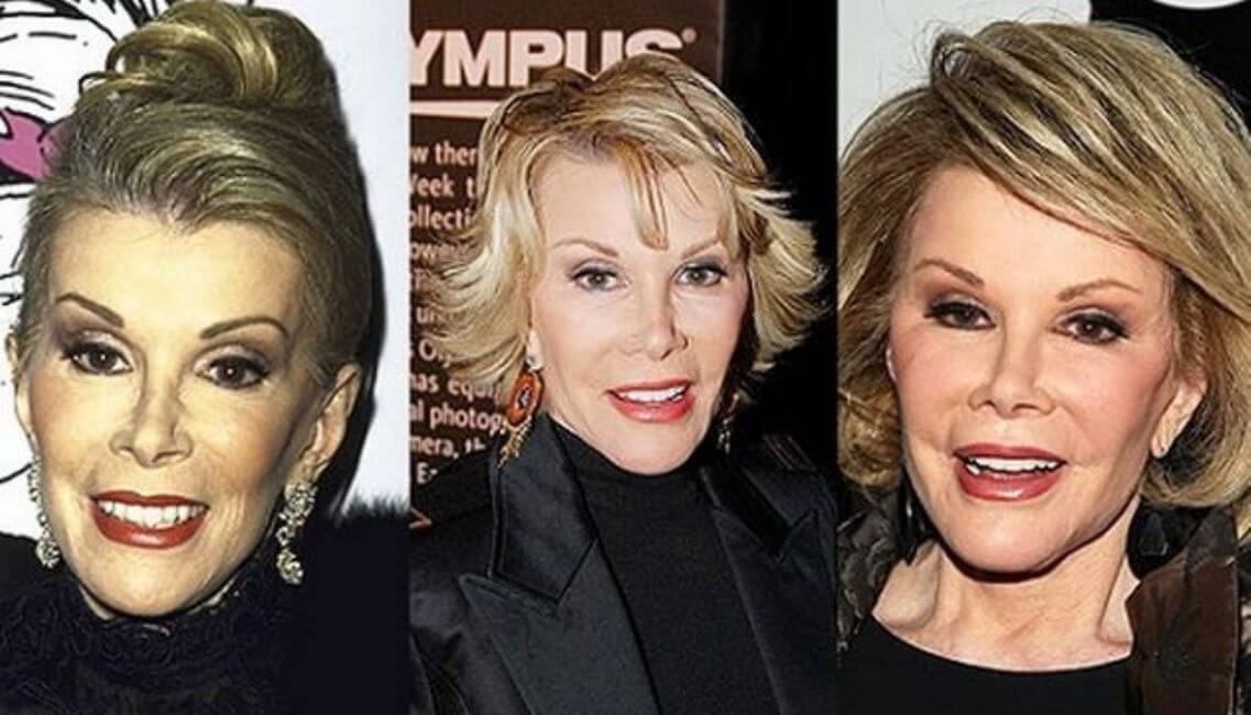 Joan Rivers Plastic Surgery Cost