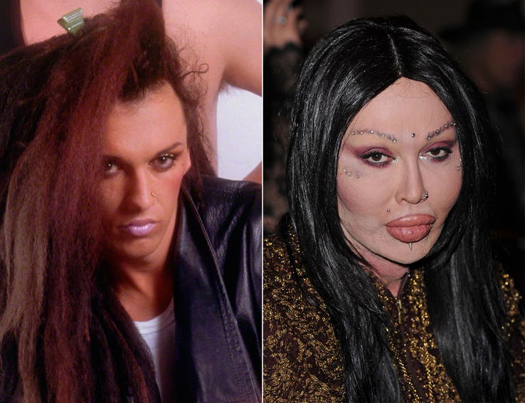 Pete Burns Plastic Surgery Cost