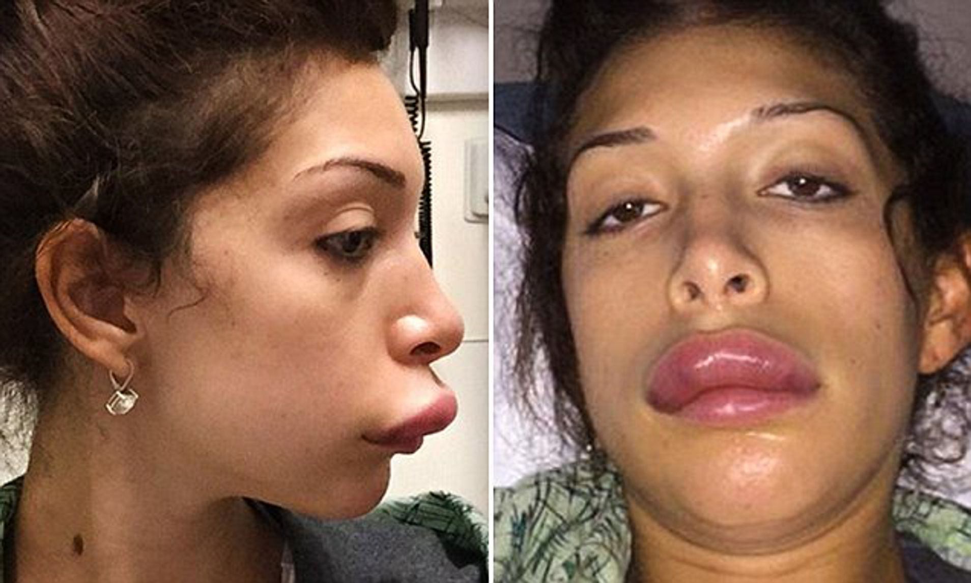 Celebrities Who Got Bad Lip Injections